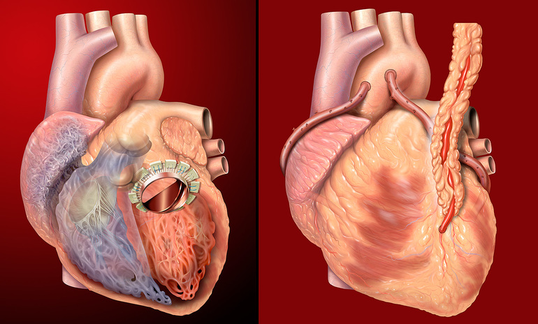 Этиология развития порока сердца