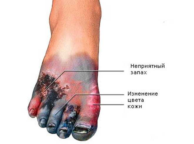 гангрена