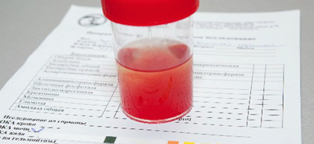 кровь в моче