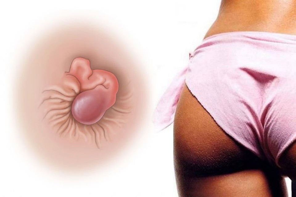 тромбоз геморроидального узла