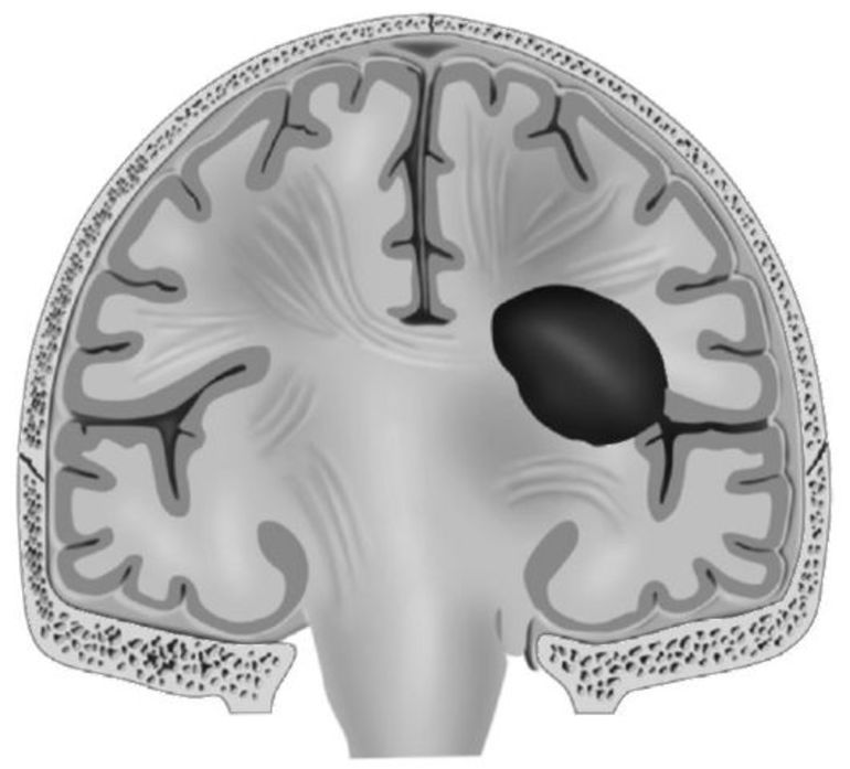 Геморрагический инсульт головного мозга