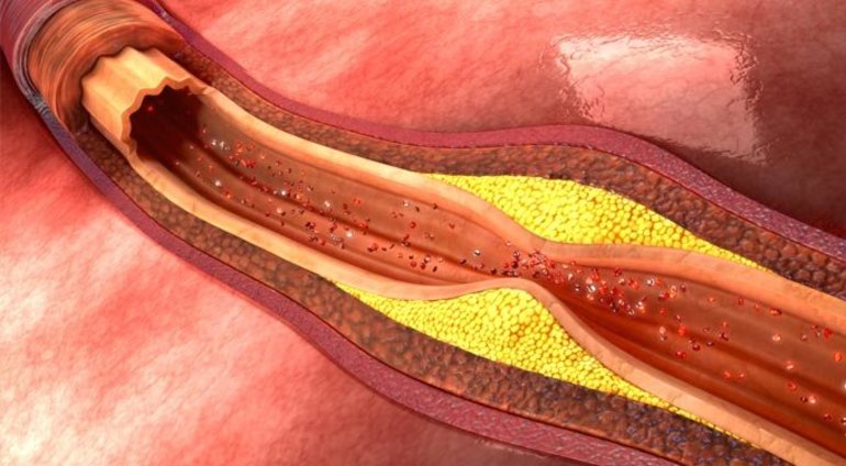 Геморрагический инсульт
