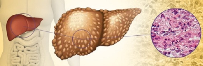 Гепатит в острой или хронической форме;