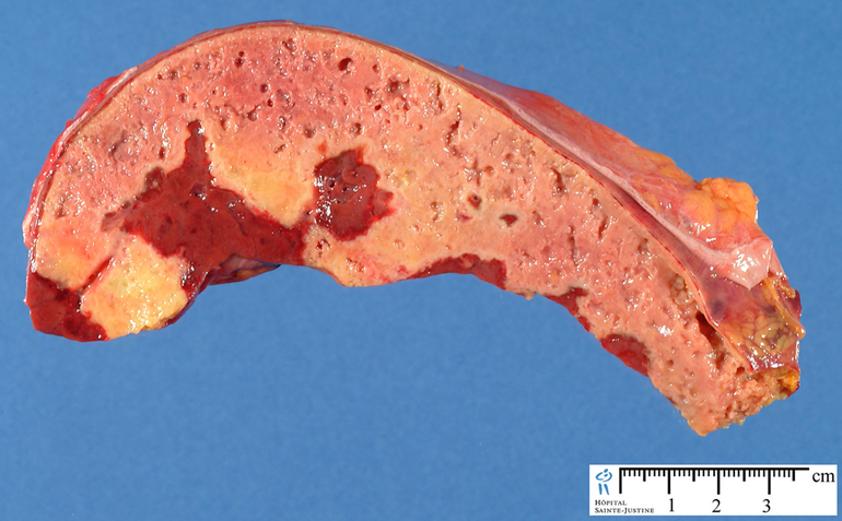 Гранулематоз вегенера