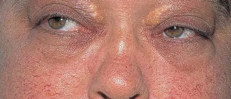 Гранулематоз вегенера диагностика