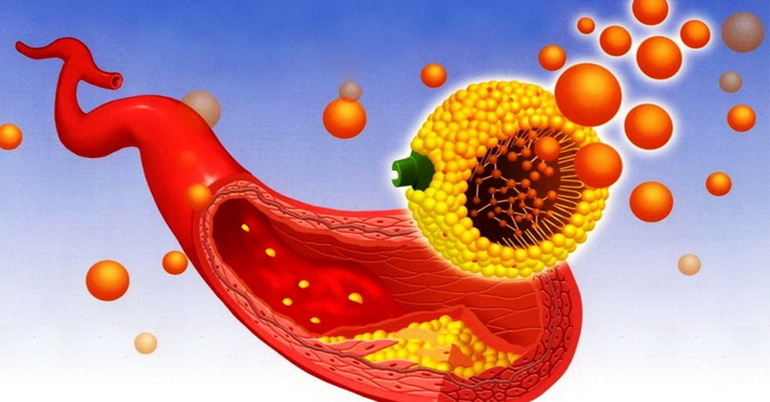 Холестерин в сосудах