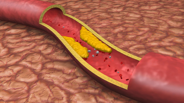 Холестириновые бляшки