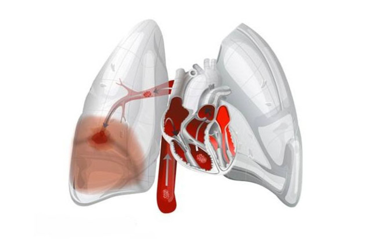 Инфаркт легкого