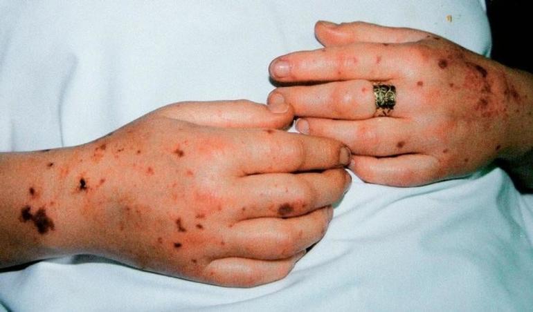 Инфекционные осложнения