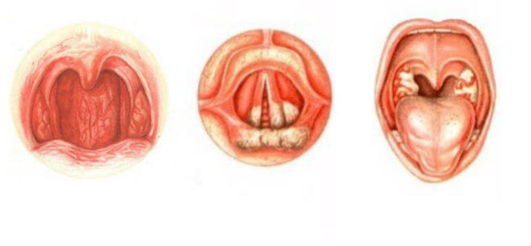 Инфекционные процессы бактериальной природы