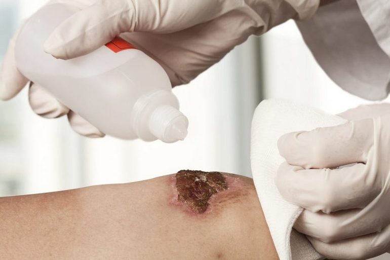 Инфекционный процесс в ране