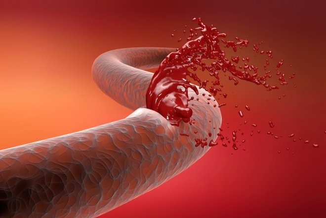 кровоизлияние