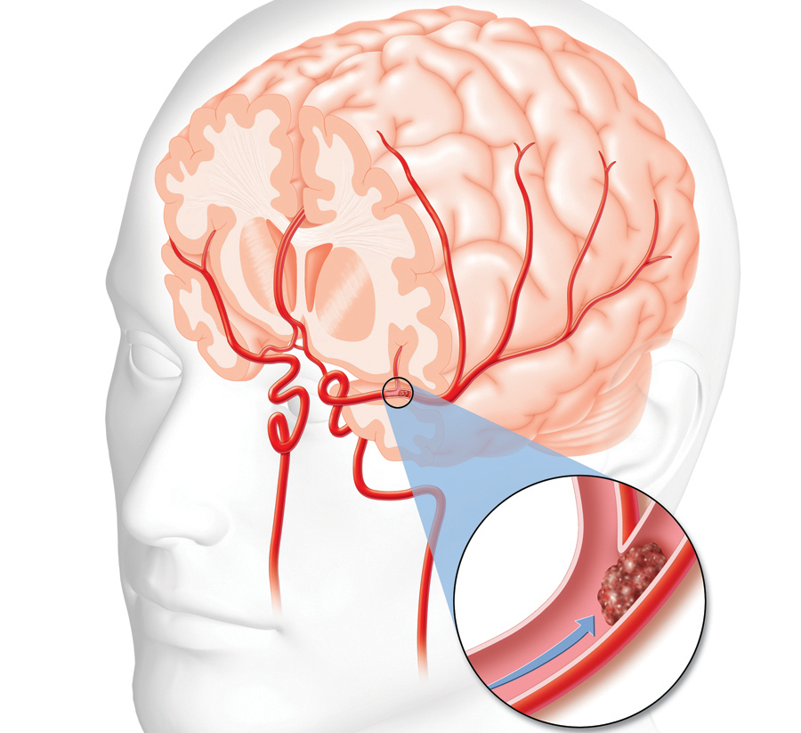 Ишемический инсульт