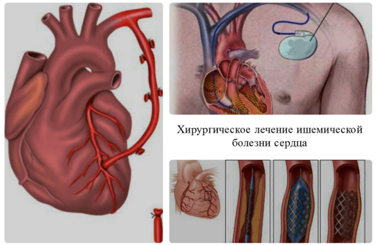 Ишемическая болезнь сердца лечение