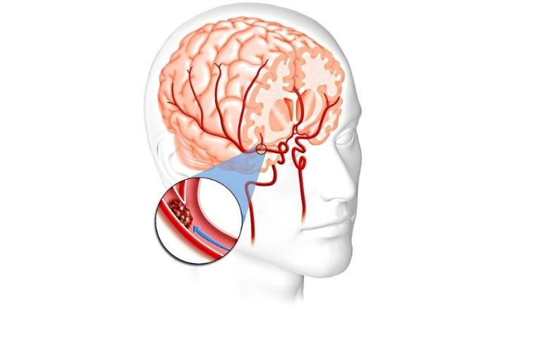 Ишемический инсульт