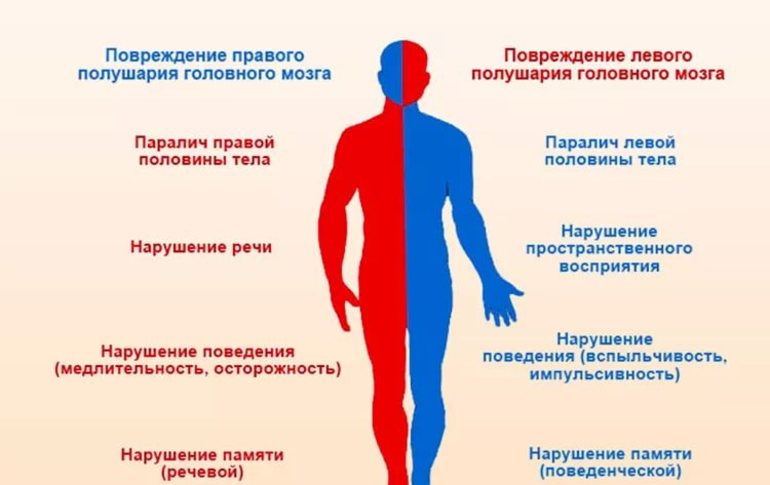 Ишемический инсульт головного мозга последствия
