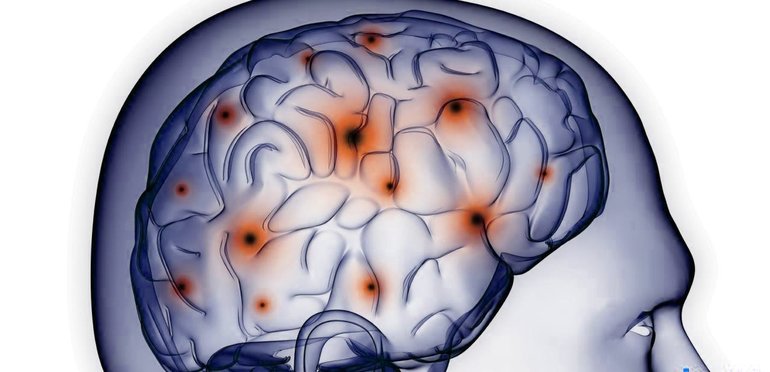 ишемический инсульт лечение