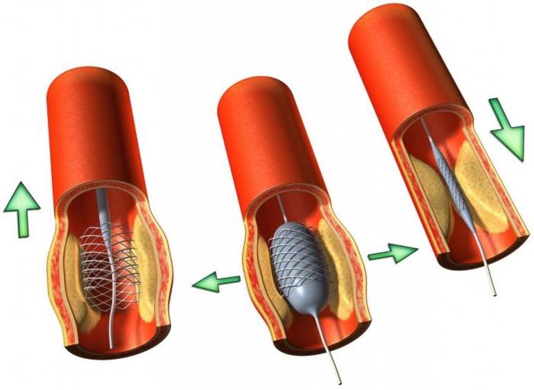Ишемия сердца
