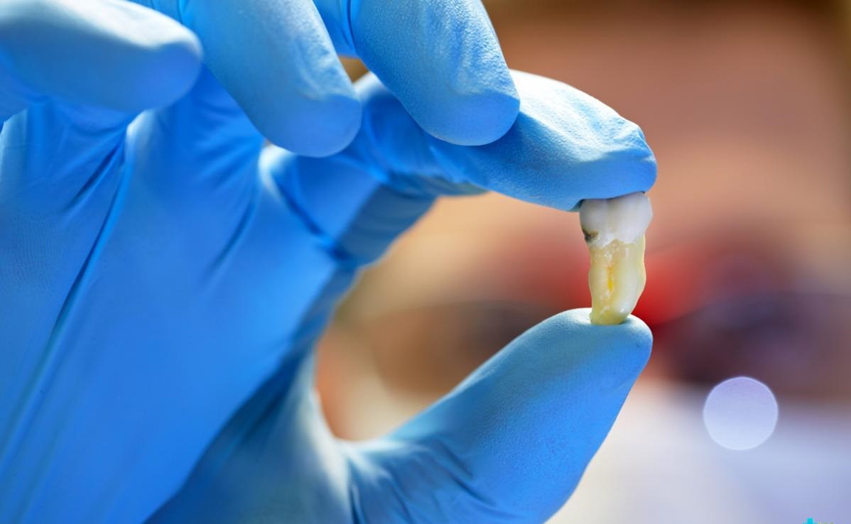 как остановить кровь после удаления зуба