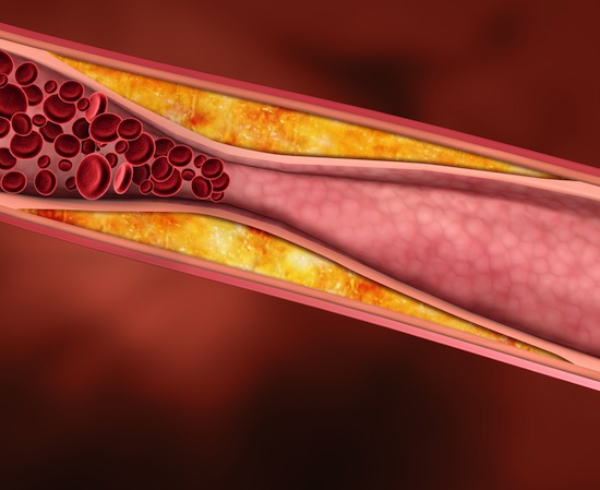 Чем можно заменить статины для снижения холестерина