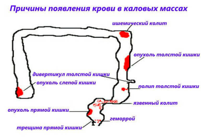 Кал с кровью причины и симптомы