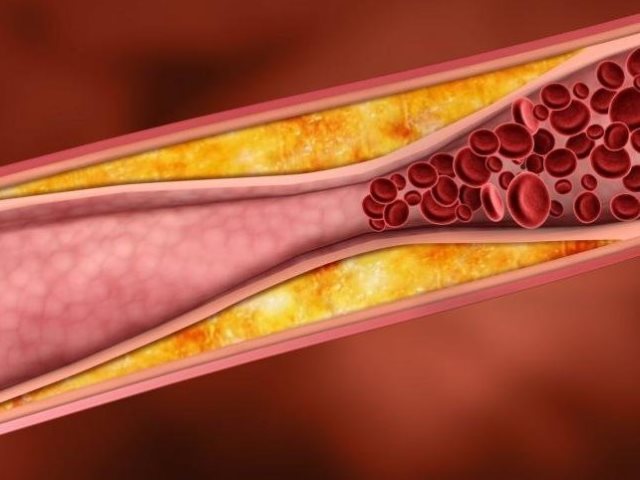 кальциноз сосудов