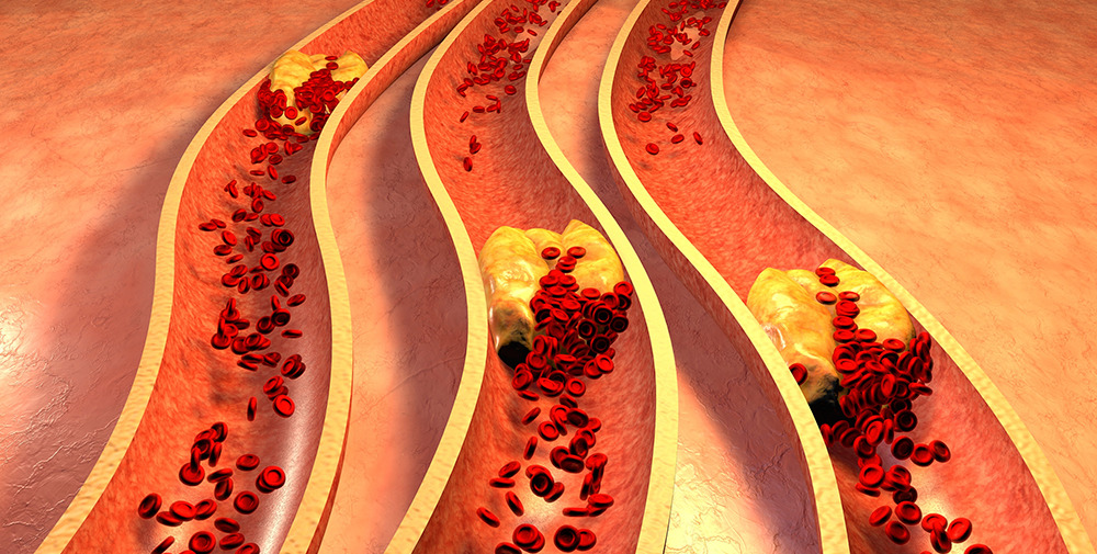 кальциноз сосудов