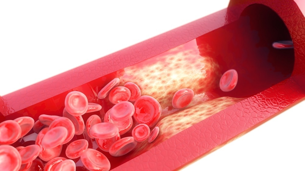 кальциноз сосудов