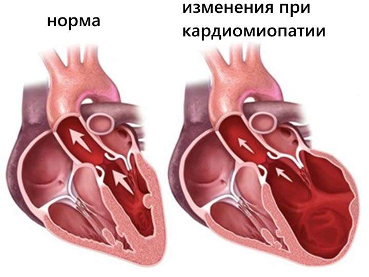 алкогольная кардиомиопатия