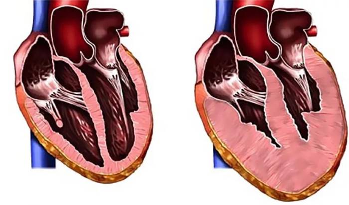 Увеличение объема сердца