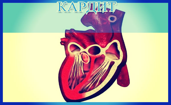 вирусный кардит