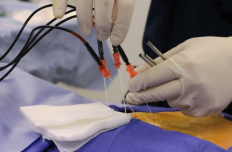 Катетерная абляция