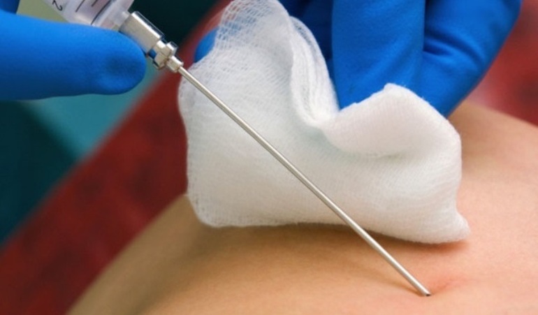 При кисте назначается пункция.