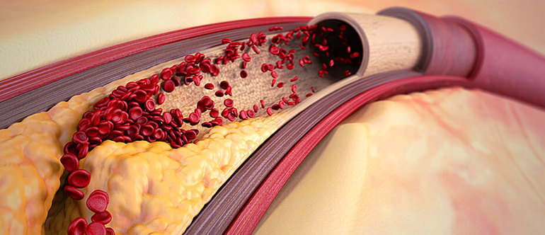 Клиническая картина атеросклероза