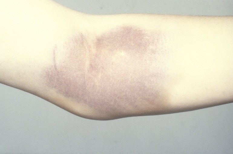 Клиническая картина гемофилии