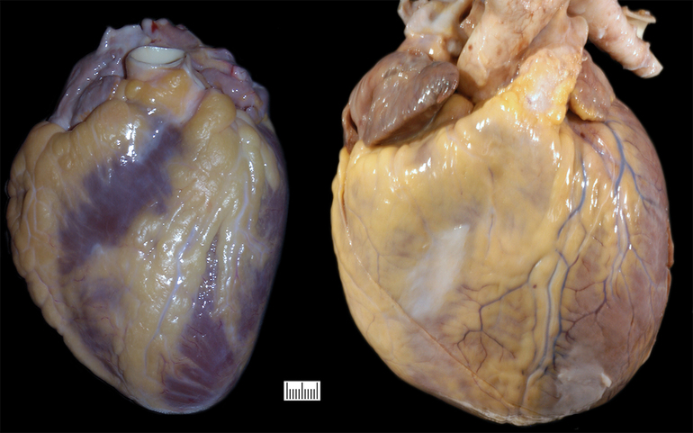 Клиническая картина заболевания кардиомиопатия