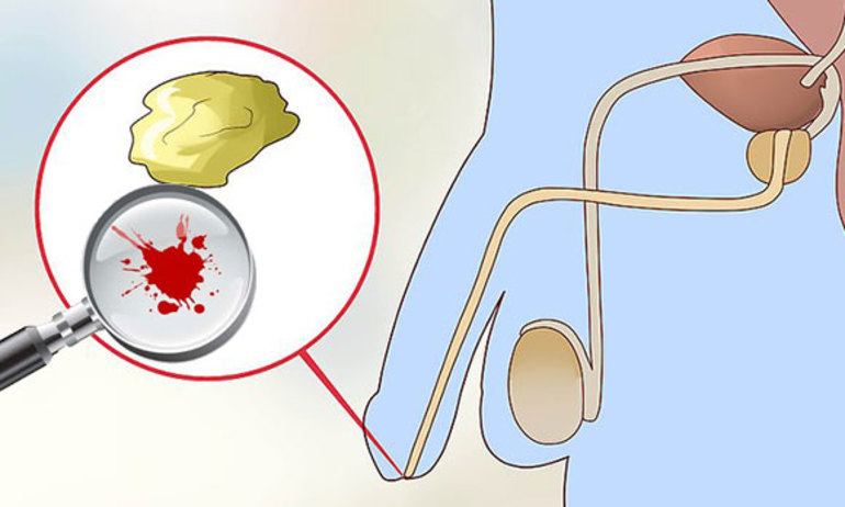 Кровь в семенной жидкости