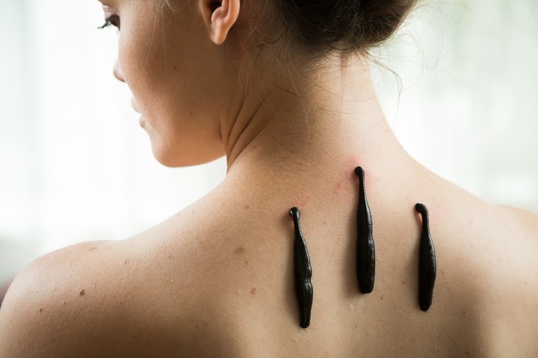 Кровопускание в домашних условиях