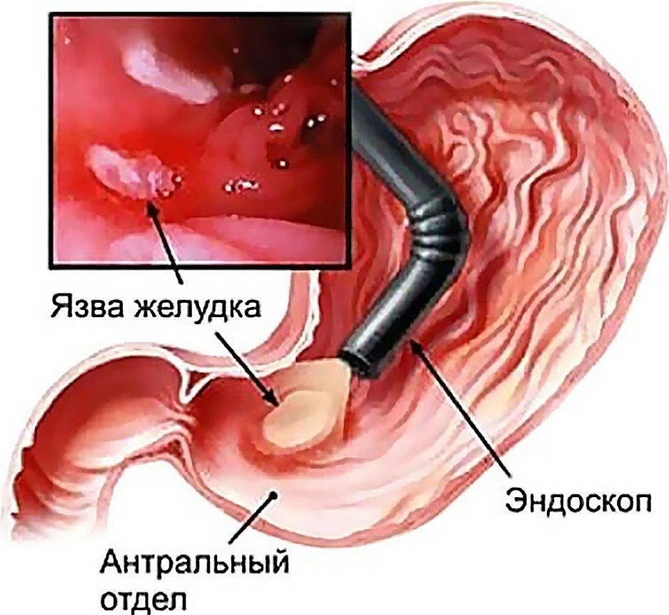 желудочное кровотечение