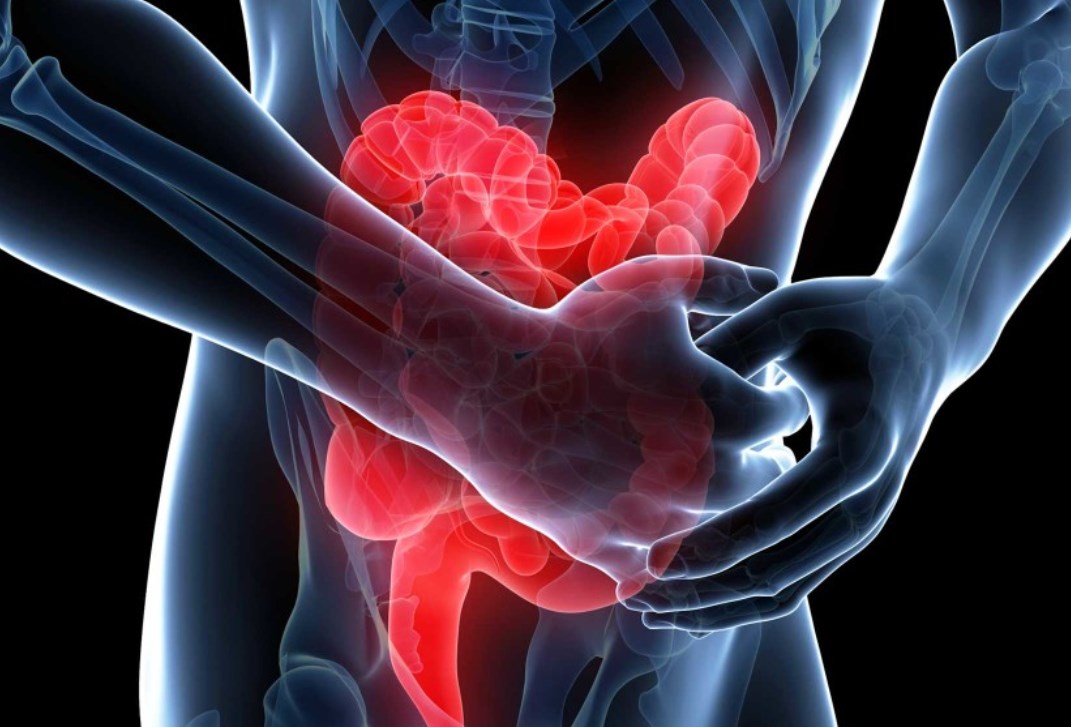 Кишечное кровотечение