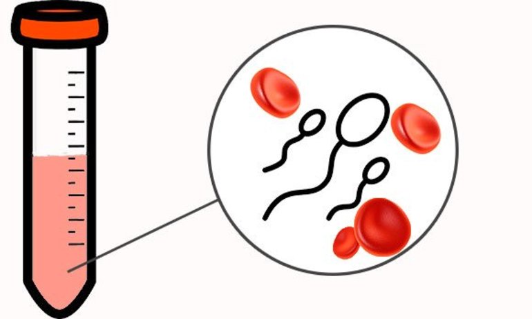 Кровянистые выделения в сперме