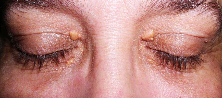 ксантелазма век