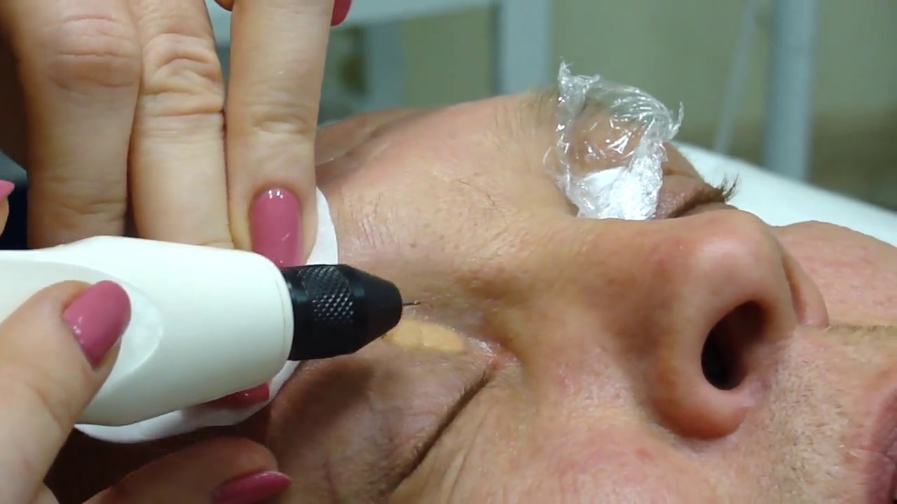 ксантелазма век