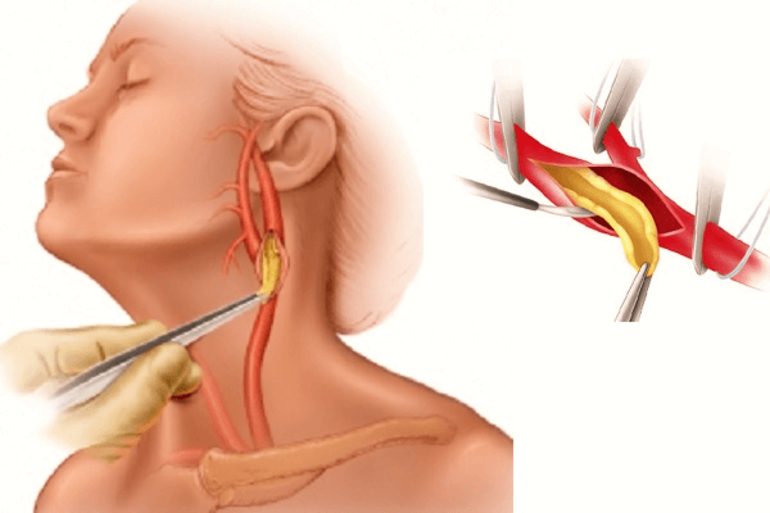 Как лечить атеросклероз сосудов головного мозга