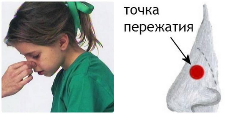 Как лечить кровотечение из носа