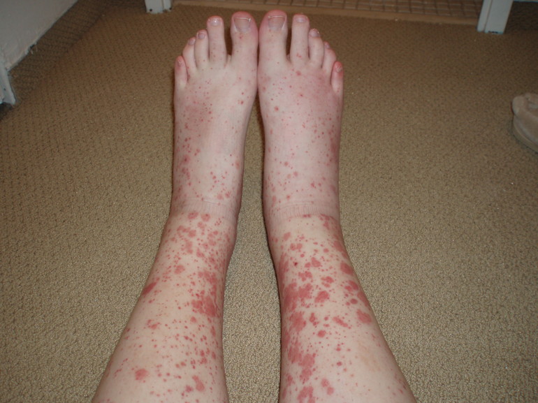 Как лечить васкулит