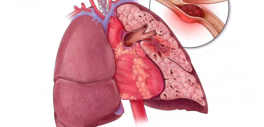 легочная эмболия