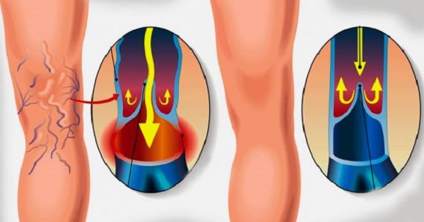 венозный рефлюкс