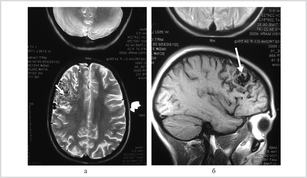 Мальформация сосудов головного мозга