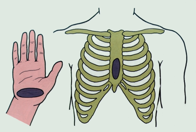 Массаж сердца непрямой